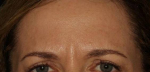 Botox - Case #4 After